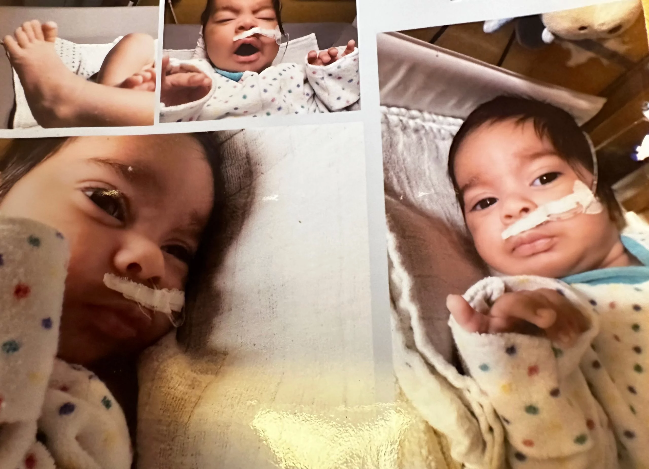 Fotocollage eines Babys mit einer über die Nase geführten medizinischen Sonde.